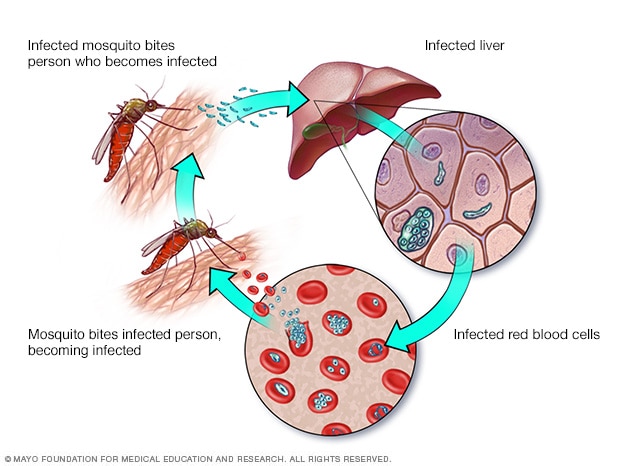 Malaria: penyebab, gejala dan pengobatan