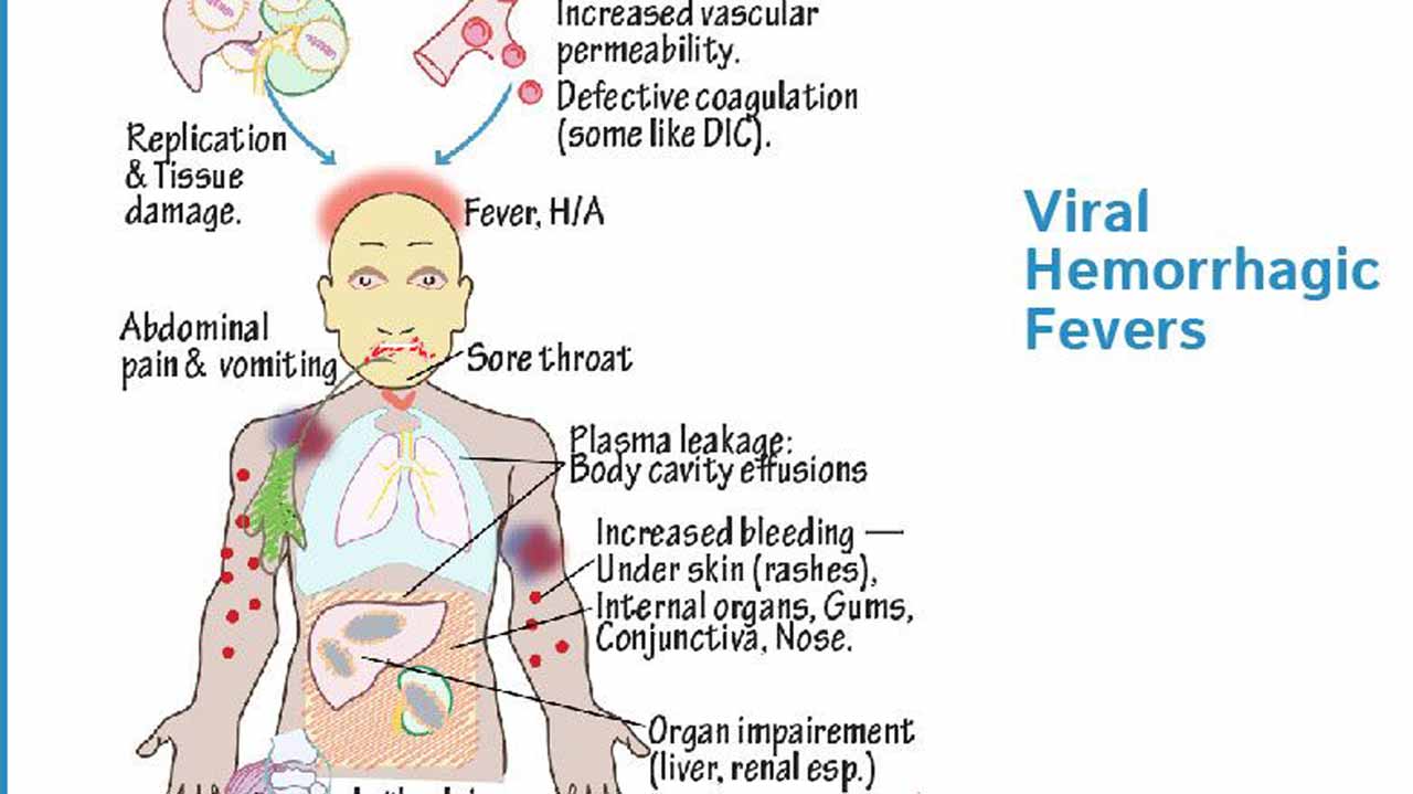 Gejala demam berdarah virus